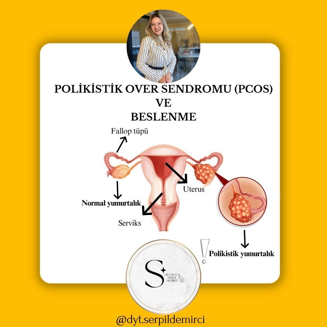 Polikistik Over Sendromu (PCOS) ve Tıbbi Beslenme Tedavisi